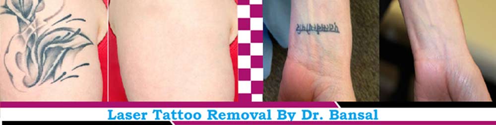 Tattoo Removal Treatment In Chandigarh | Tattoo removal in chandigarh
